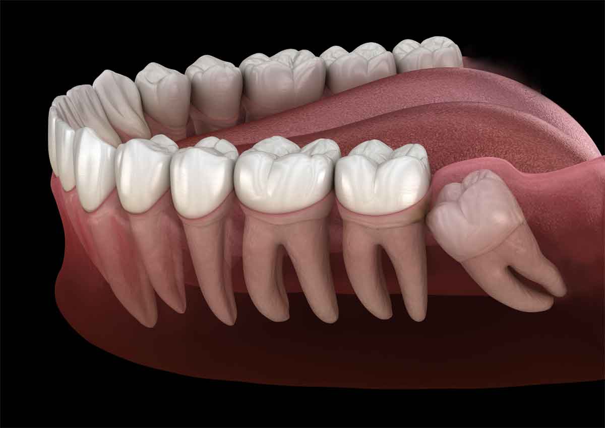 Estrazione Denti del Giudizio