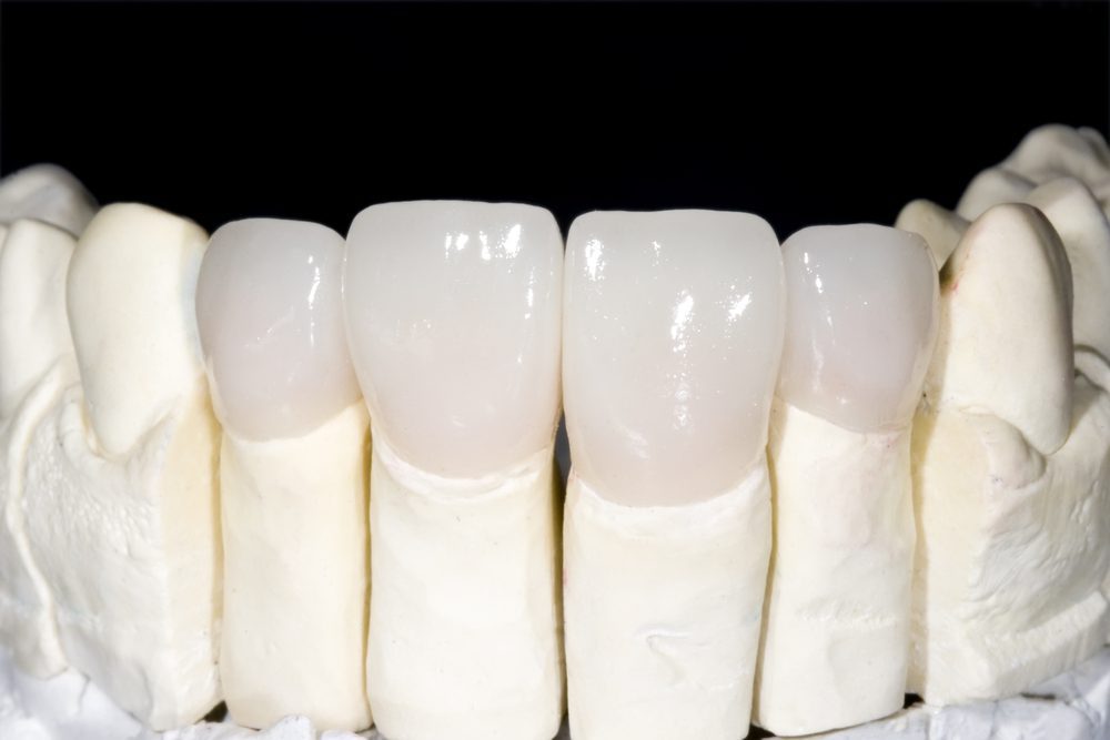 Corone in Zirconia